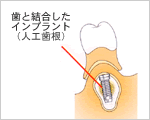 図：歯と結合したインプラント（人工歯肉）