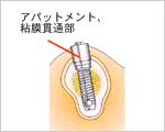 図：アバットメント、粘膜貫通部